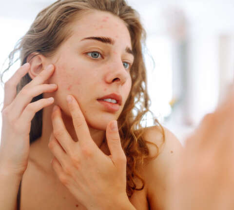 ¿Cuándo ver a un dermatólogo por acné? Guía médica para saber el momento adecuado