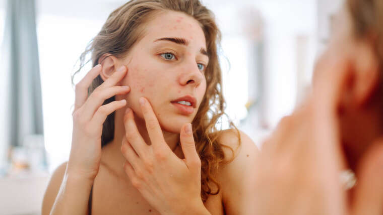 ¿Cuándo ver a un dermatólogo por acné? Guía médica para saber el momento adecuado