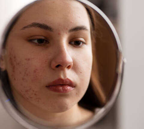 ¿Por qué empeora el acné? Causas reales que lo agravan