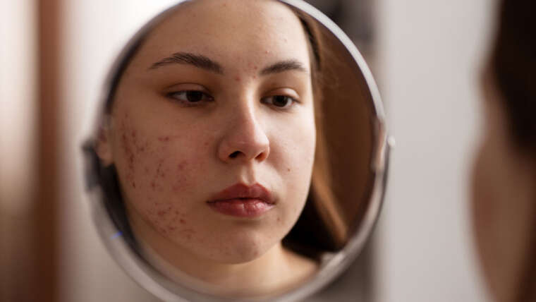 ¿Por qué empeora el acné? Causas reales que lo agravan